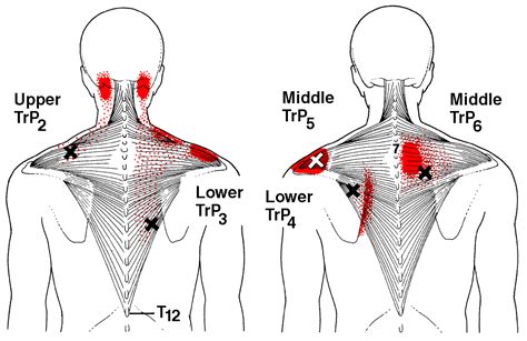 A common cause of pain between the shoulder blades is muscle strain. . Burning sensation in upper back shoulder blades